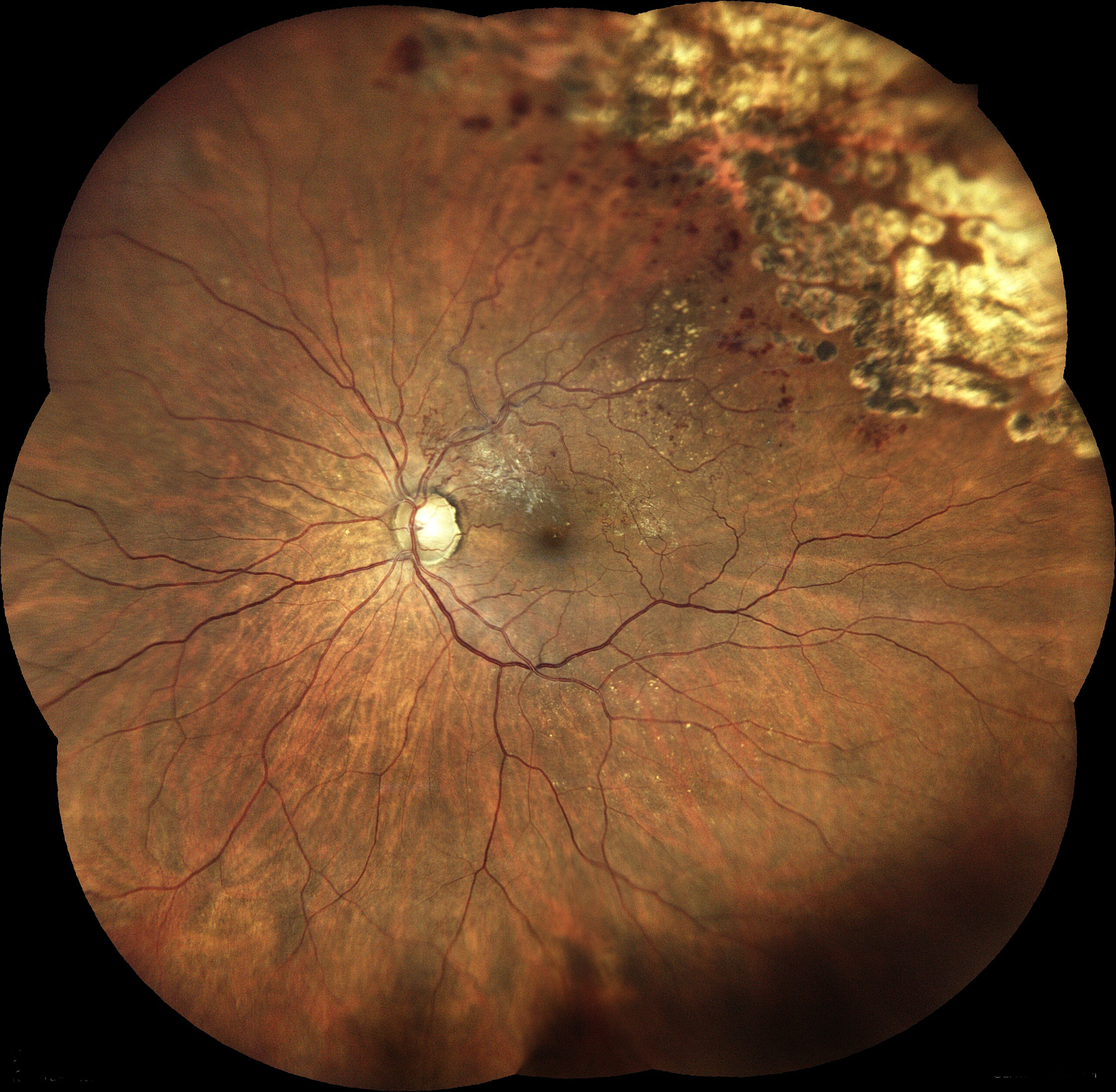 iCare EIDON retinal görüntü örneği küçük görsel